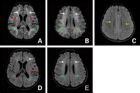 ofgfap|Glial Fibrillary Acidic Protein